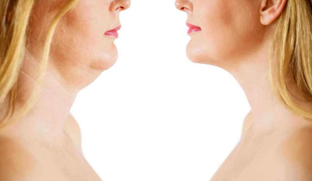 Double Chin treatment Tolworth before and after results