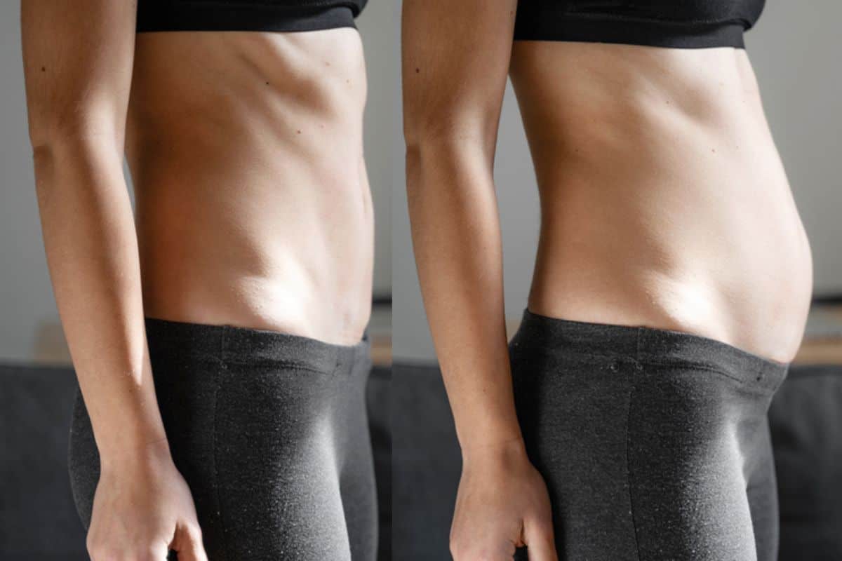 How long does diastasis recti take to improve Tolworth?