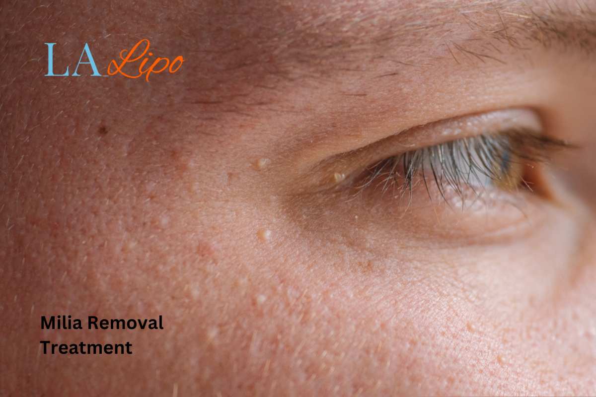 Cryopen Milia Removal: Is It the Easiest and Safest Option Tolworth?