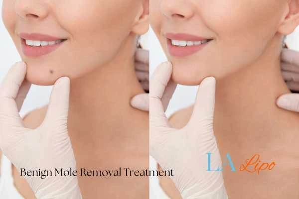 Before-and-after results following benign mole-removal treatment Tolworth