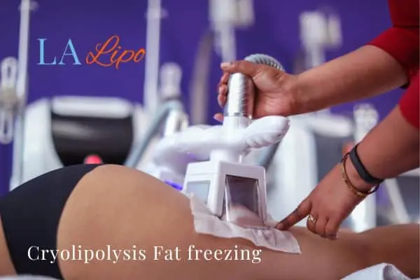 women getting fat freezing Tolworth