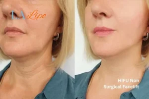 hi-fu for wrinkles Tolworth before and after results