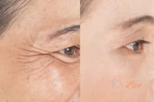 Before and after results of woman - HI-fu wrinkles reduction treatment Tolworth