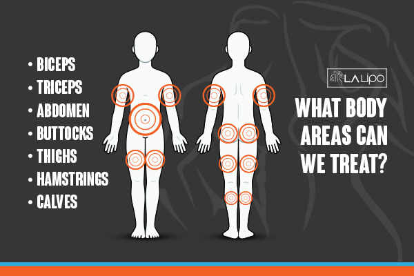 Graphic to show areas you can have LA-EMS Body Sculpting Tolworth treatment.