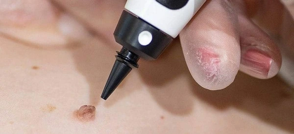 skin tag removal using cryopen Tolworth