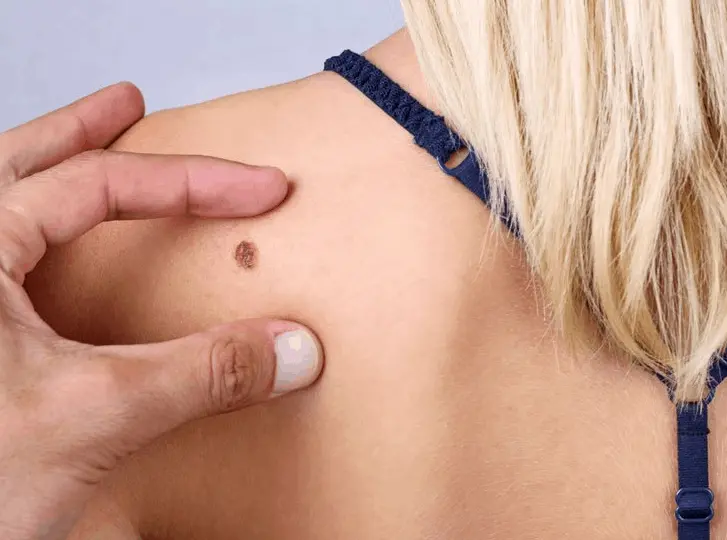woman having mole removal Tolworth consultation before treatment.