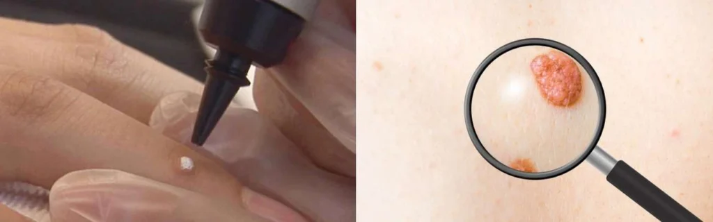 CryoPen practitioner Tolworth assessing a benign mole before treatment