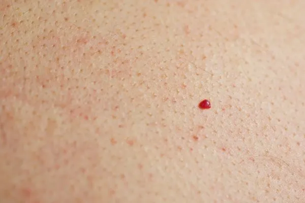 close up of a cherry angioma Tolworth