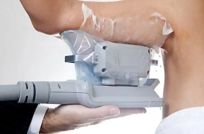 Picture of fat freezing Tolworth on the upper arms.