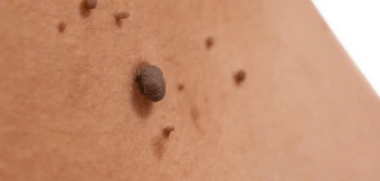 image of a skin tag Tolworth