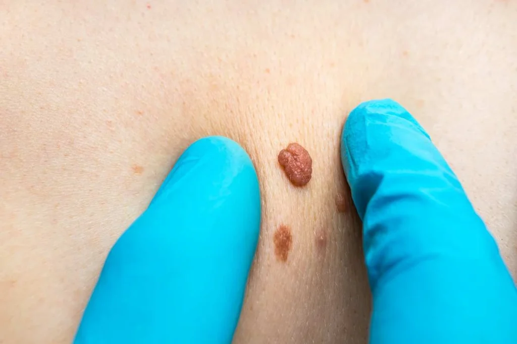 Consultant examining a skin tag Tolworth
