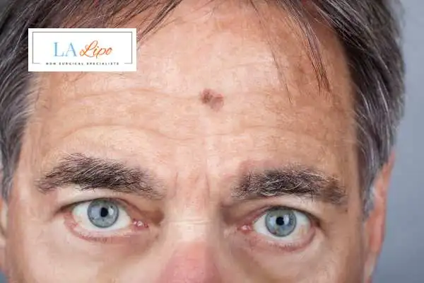 Solar Lentigo Removal Tolworth image of man with mark on his forehead