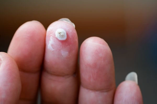 wart on person finger - cryotherapy to treat from LA LIPO Tolworth