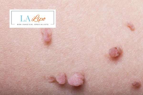 Does cryopen skin tag removal Tolworth hurt? Find out now call our team today!