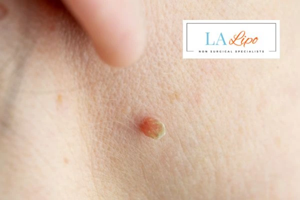Book skin tag removal Tolworth today speak to our team now!