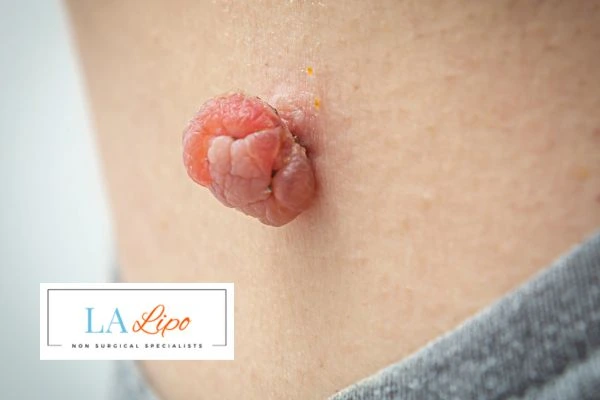 Interested in skin tag removal Tolworth? Concerned about the pain? Find out more today!