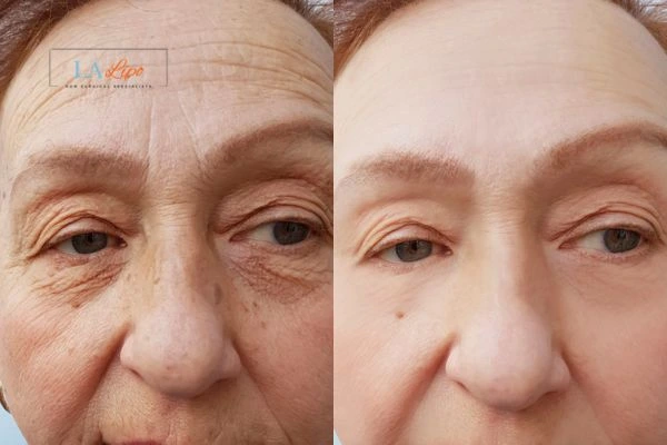 The powerful benefits of Morpheus8 Treatment Tolworth - Call Our team today!