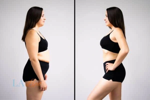 Picture of womans before and after using LA-EMS body sculpting to improve her core strength Tolworth
