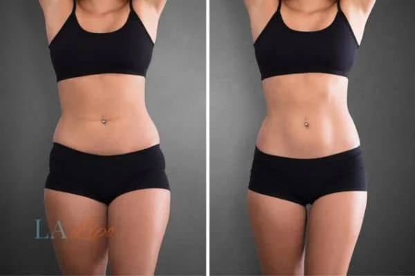 before and after results of non-surgical treatment to help a woman's body image and mental health Tolworth