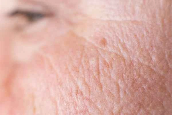 close up picture of a woman's face showing an age spot Tolworth