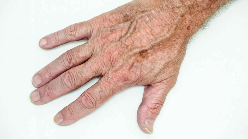 Male hand showing age spot Tolworth