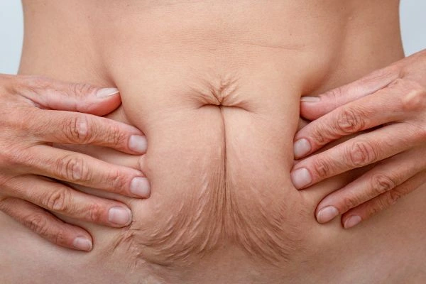 Should I Combine Diastasis Recti Treatment with Body Contouring for Better Results Tolworth?