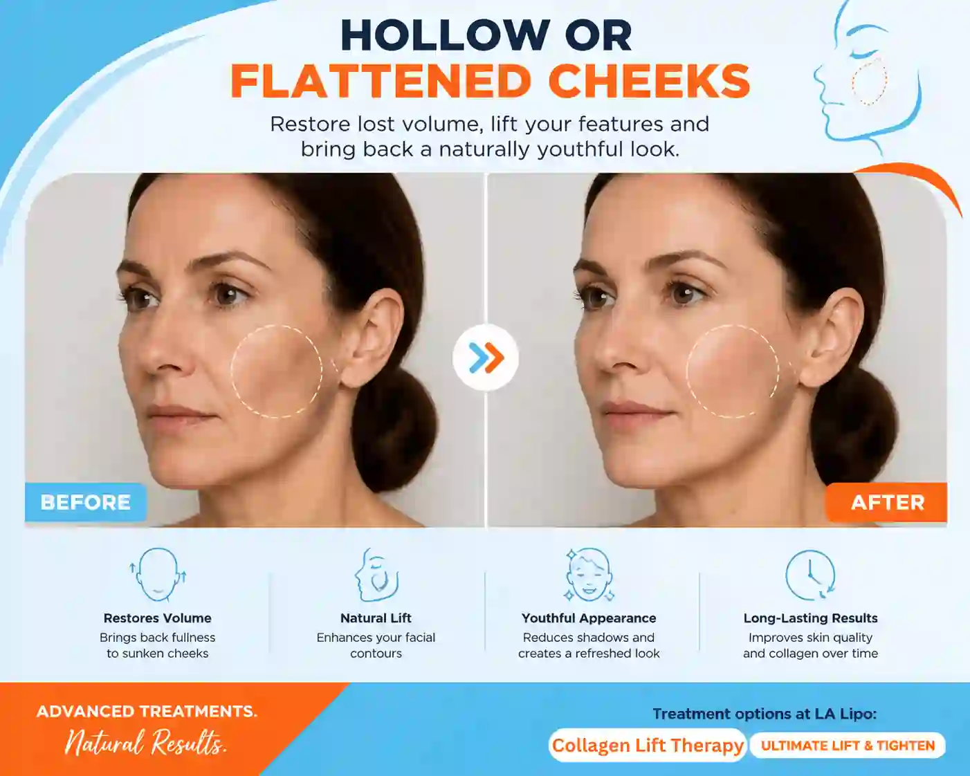 Sign #4: Hollow or Flattened Cheeks Tolworth