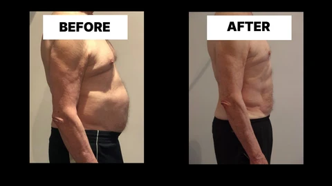 What Symptoms Can Diastasis Recti Cause in Men? Weak Core, Back Pain and Poor Posture Tolworth
